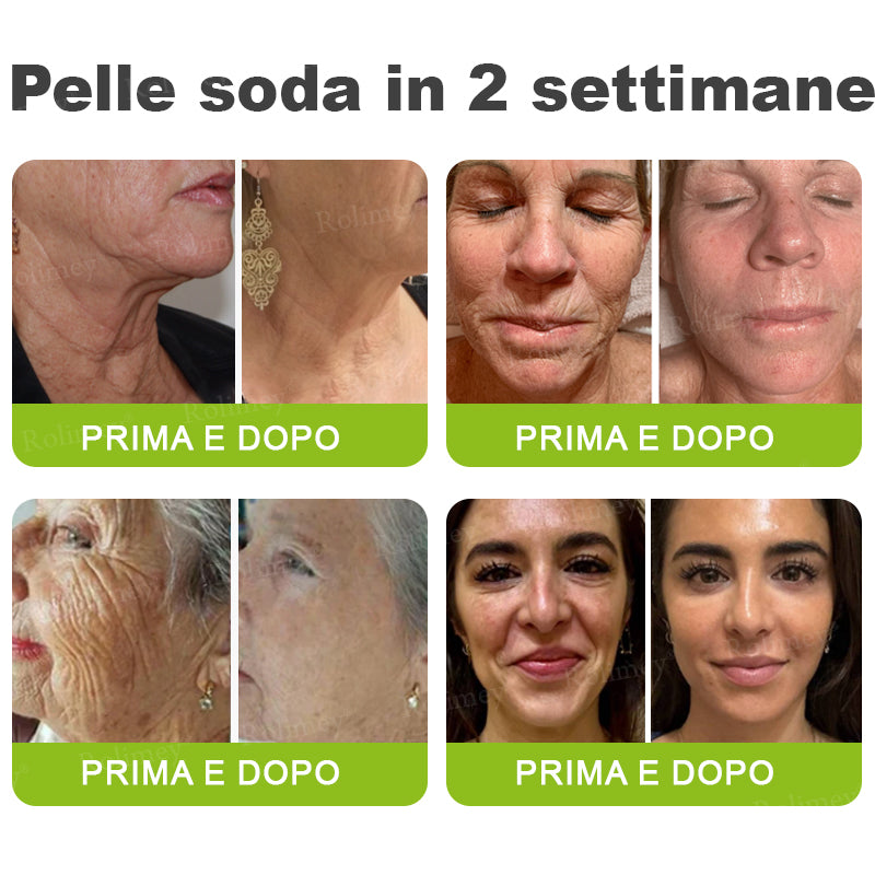 👨🏻‍⚕️ Rolimey® Crema Lifting Antirughe Effetto Botox & Retinolo Vita-A - Ultimo giorno di promozione: 70% di sconto|