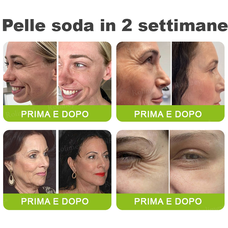 👨🏻‍⚕️ Rolimey® Crema Lifting Antirughe Effetto Botox & Retinolo Vita-A - Ultimo giorno di promozione: 70% di sconto|