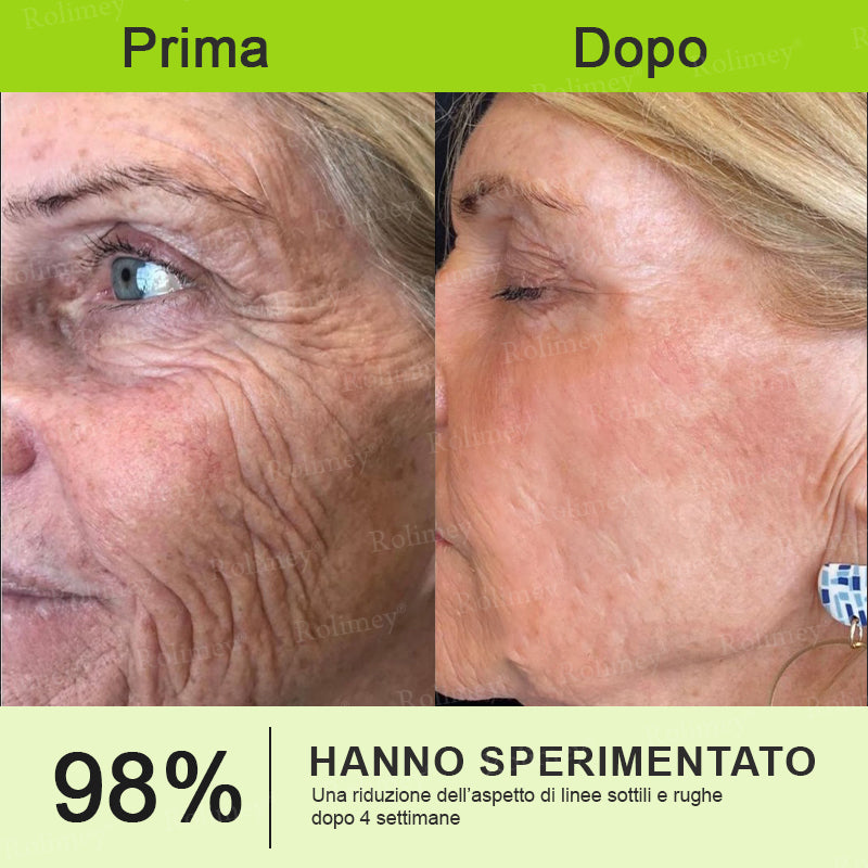 👨🏻‍⚕️ Rolimey® Crema Lifting Antirughe Effetto Botox & Retinolo Vita-A - Ultimo giorno di promozione: 70% di sconto|